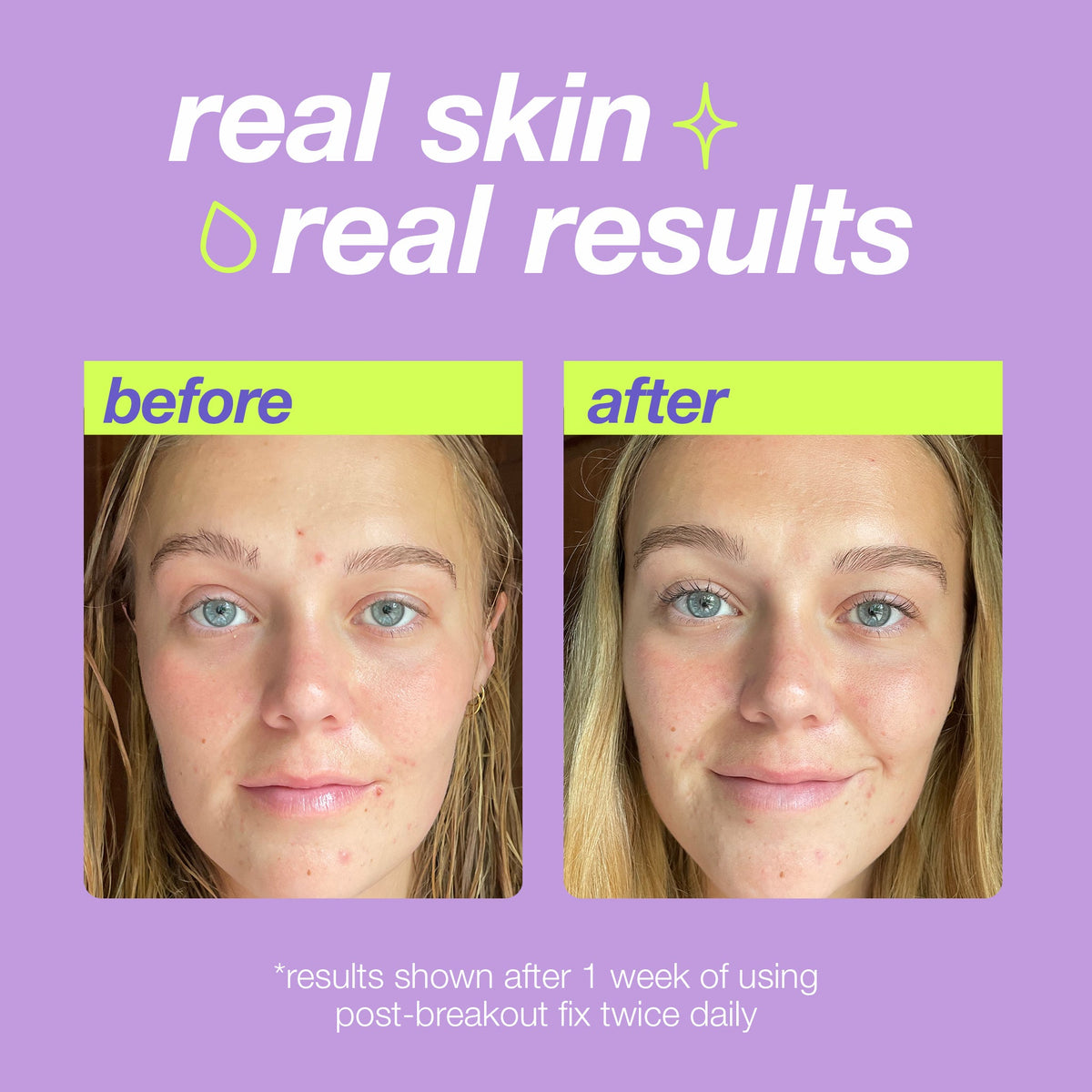 post-breakout fix real skin real results 