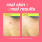clarifying bacne spray real skin real results