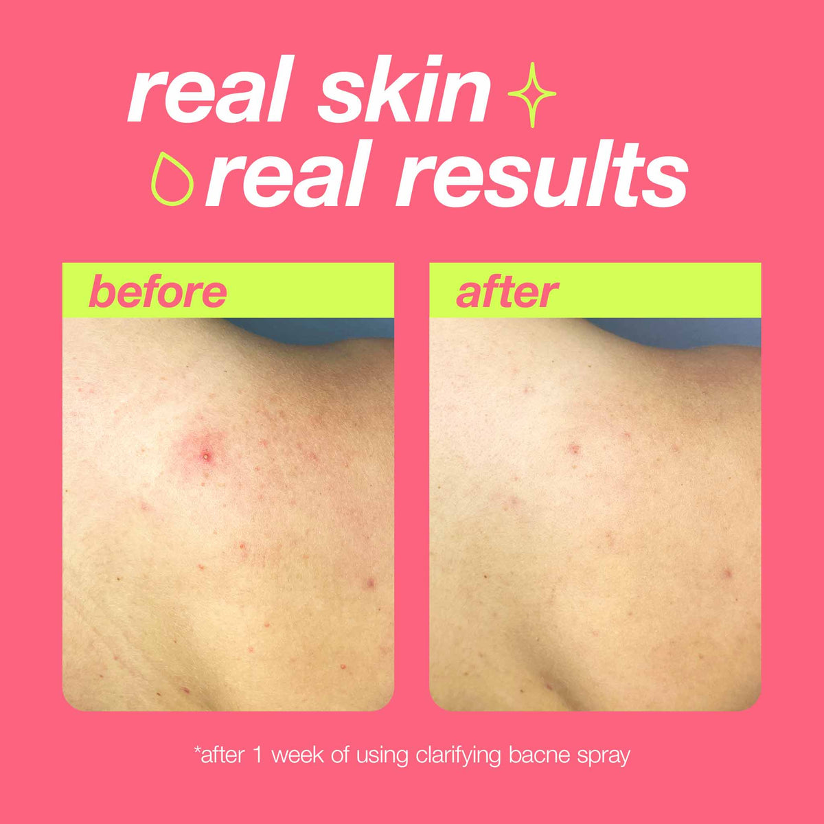 clarifying bacne spray real skin real results 
