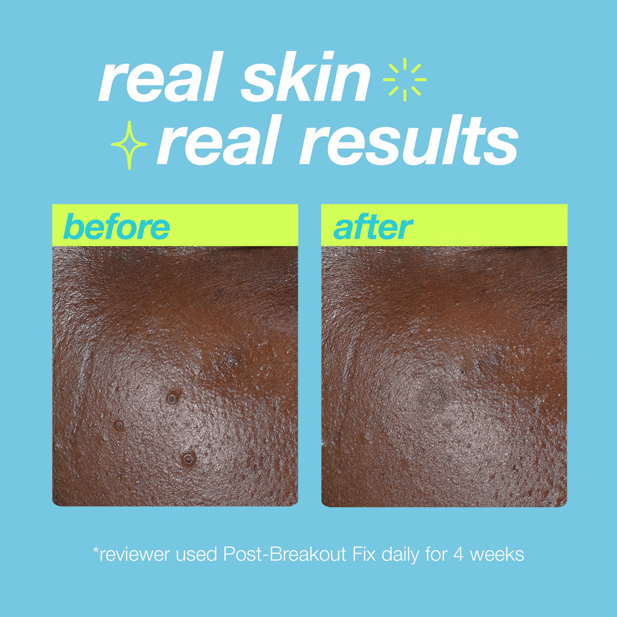 post-breakout fix real skin real results 