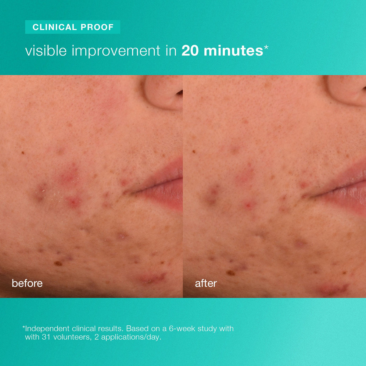 acne biotic moisturizer clinical proof 