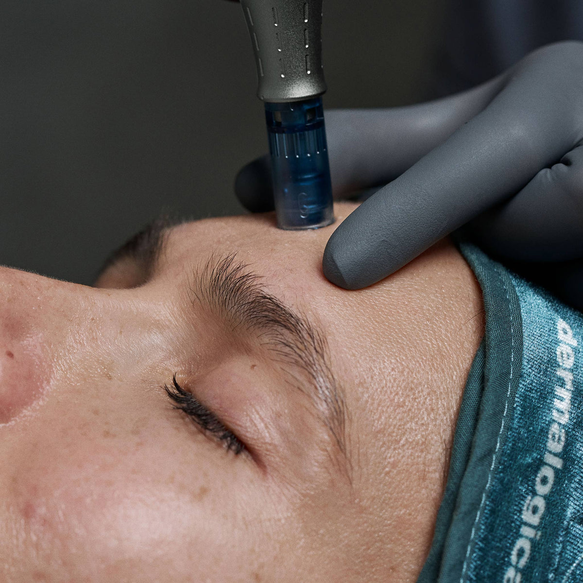 model receiving skin treatment 