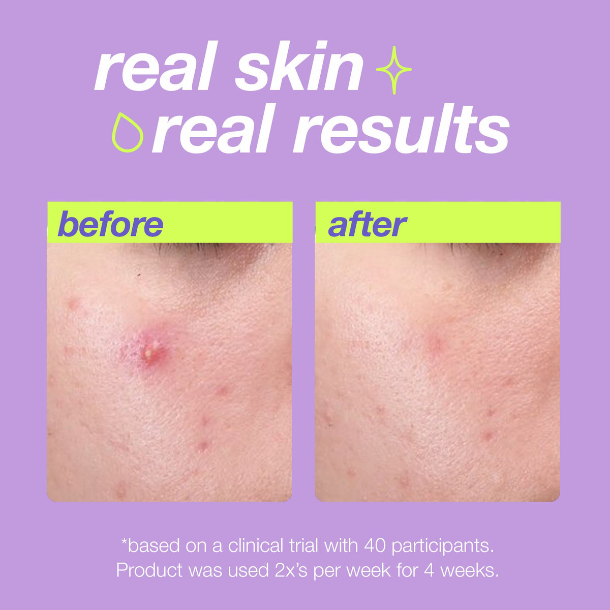 Before and after results using Breakout Clearing Liquid Peel 