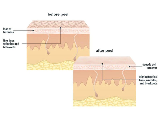 before peel and after peel graphic