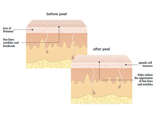 before and after peel