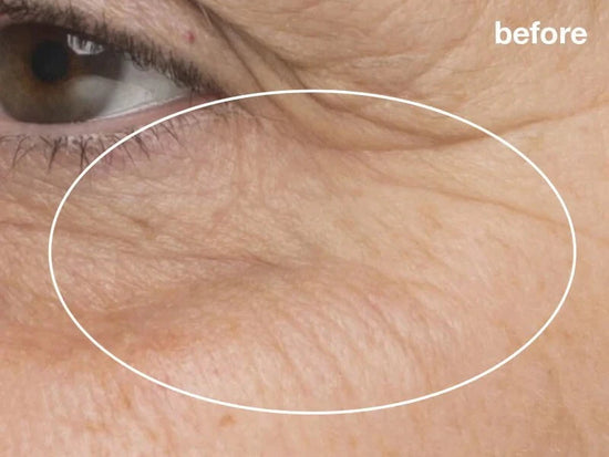 before pro power peel