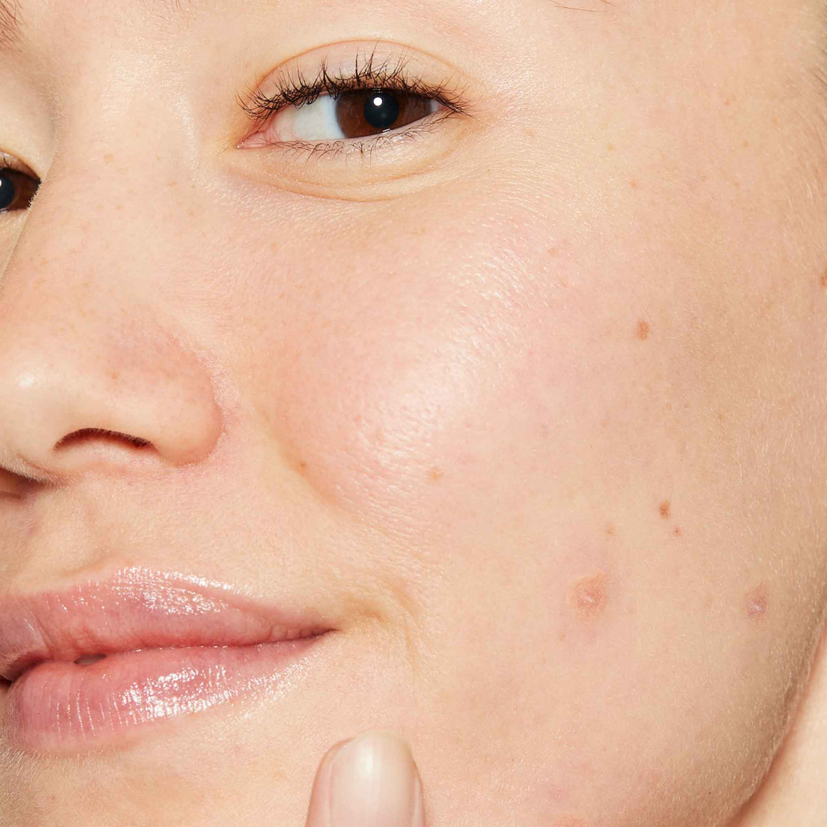 deep acne liquid patch model 